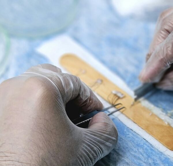 medical registry heart transplantation alerts